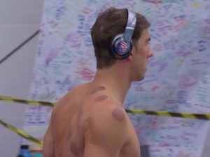 cupping marks